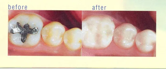 Before and after photos of a molar: first with a dark metal filling, then with a tooth-coloured filling