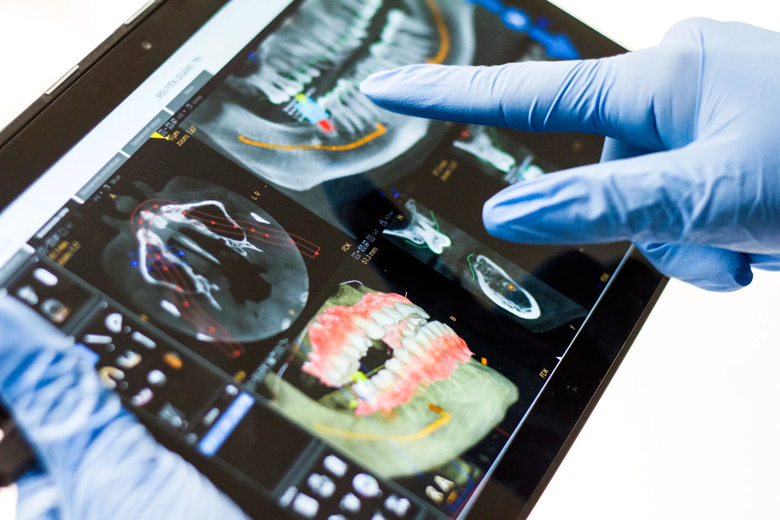 Gloved finger pointing at 3D dental scans of a jaw on a tablet screen