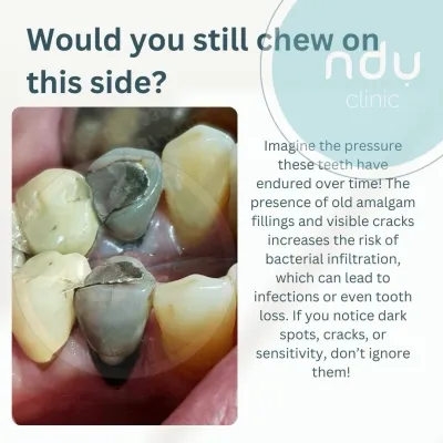 This is dental art in its true form 🦷✨ — a heavily filled, root canal–treated tooth, noticeable by the discolour