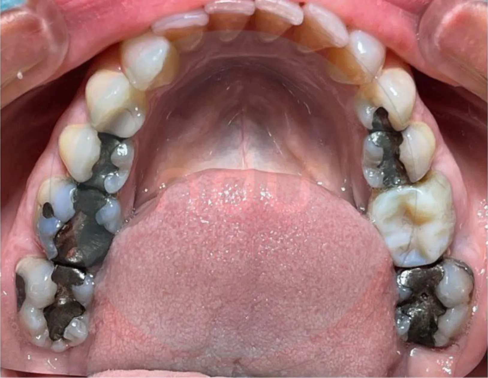 Upper teeth viewed from below, with several dark metal fillings in the back teeth