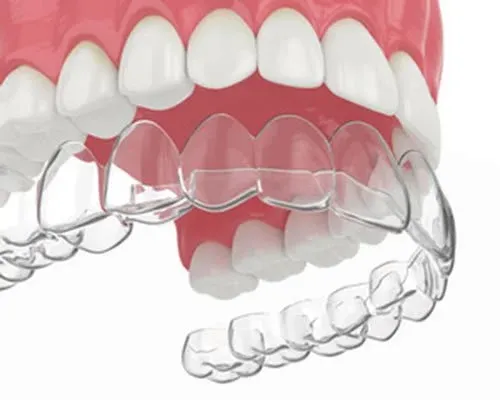 3D illustration of upper and lower teeth with a clear aligner tray being fitted