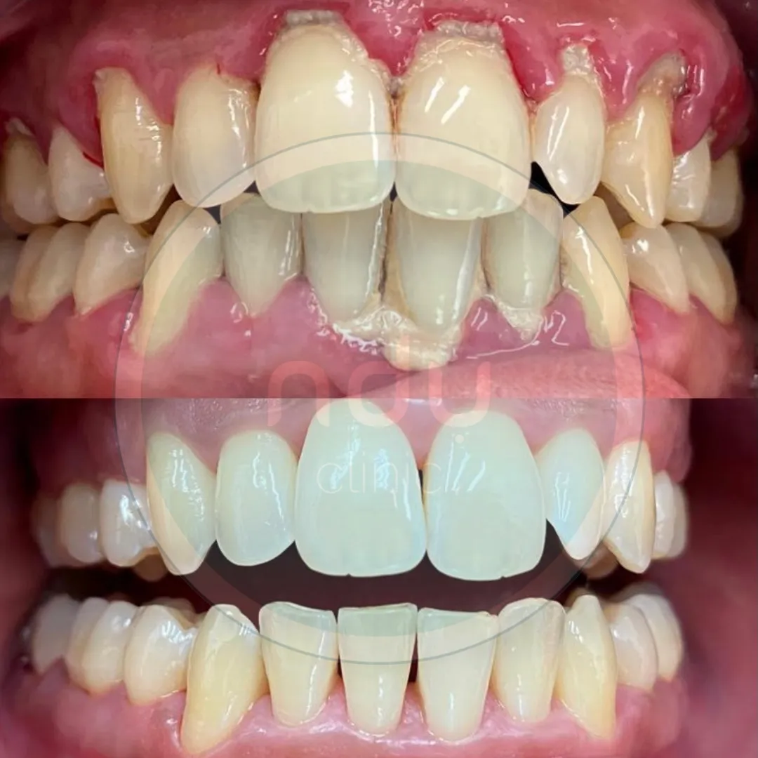 Before and after close-ups of front teeth: first with heavy yellow deposits at the gumline, then without