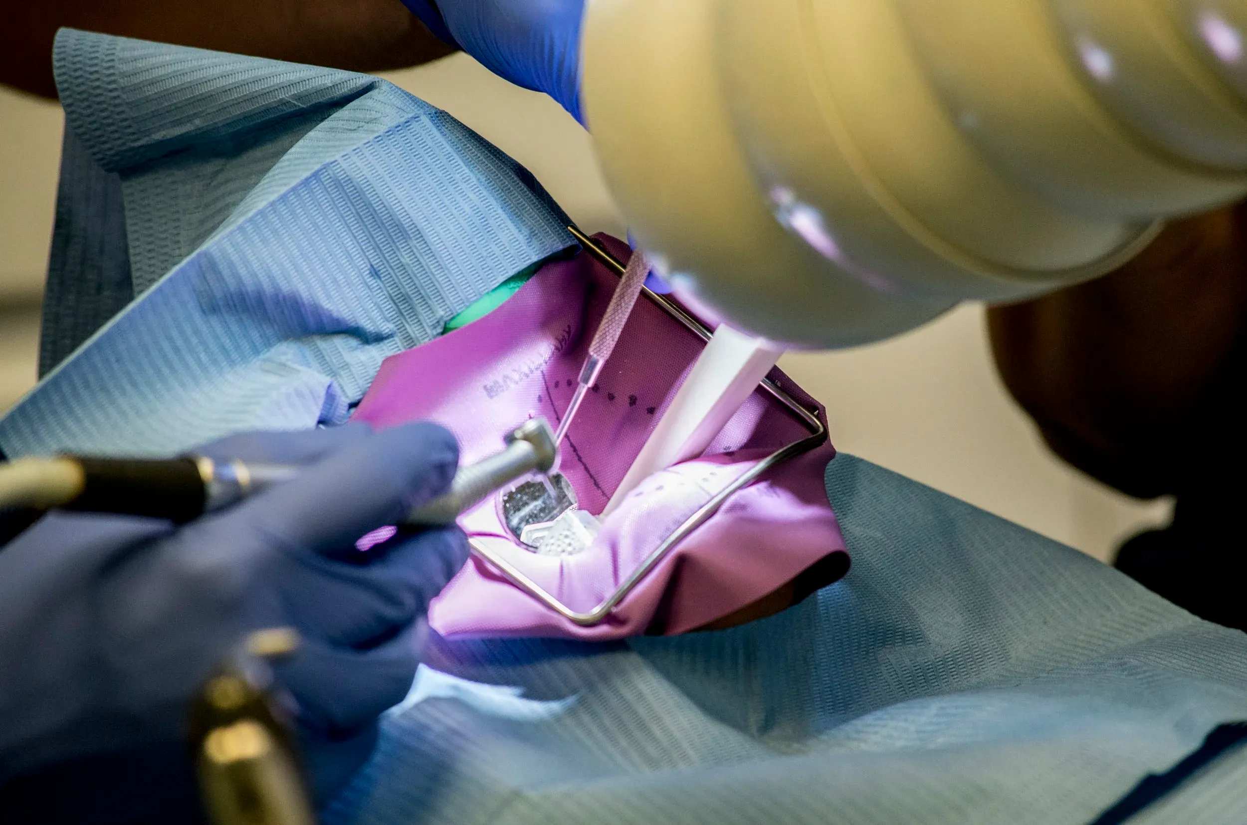 Close-up of a tooth isolated with a purple rubber dam, with a suction tip and dental handpiece in use