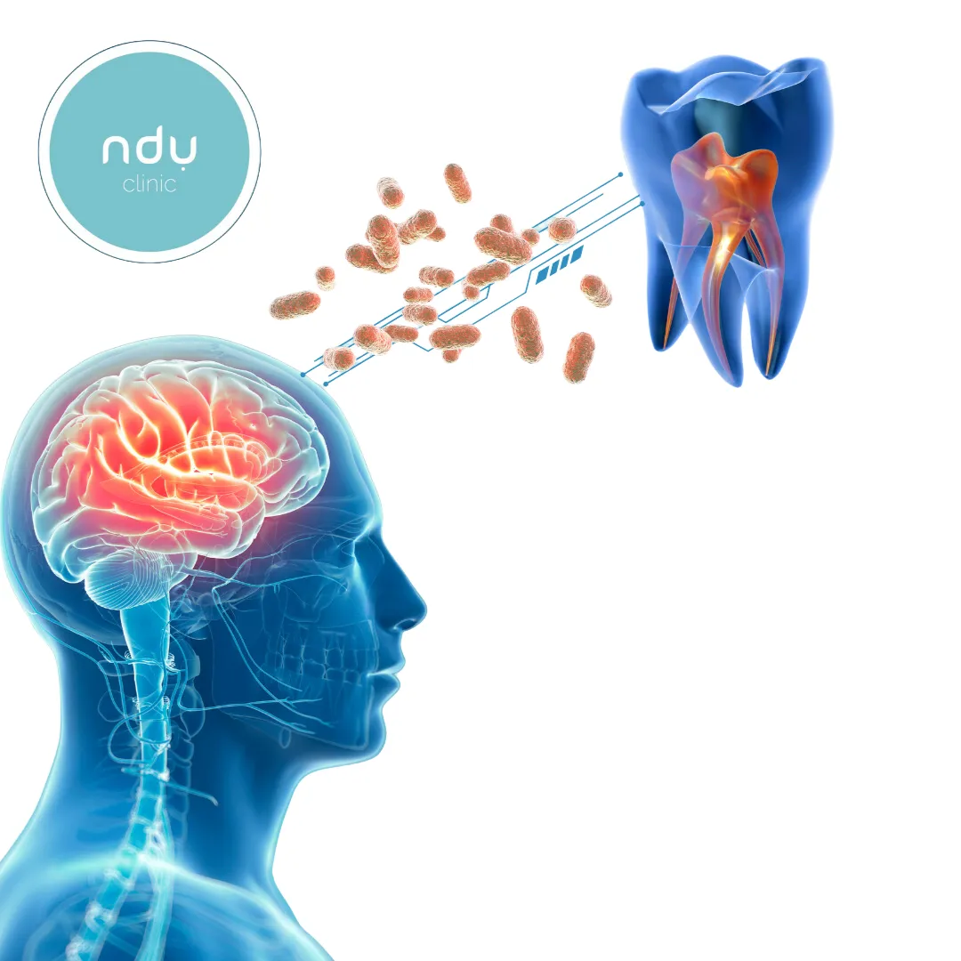 Illustration of a head with a highlighted brain, bacteria and a cut-away tooth, with the ndu logo