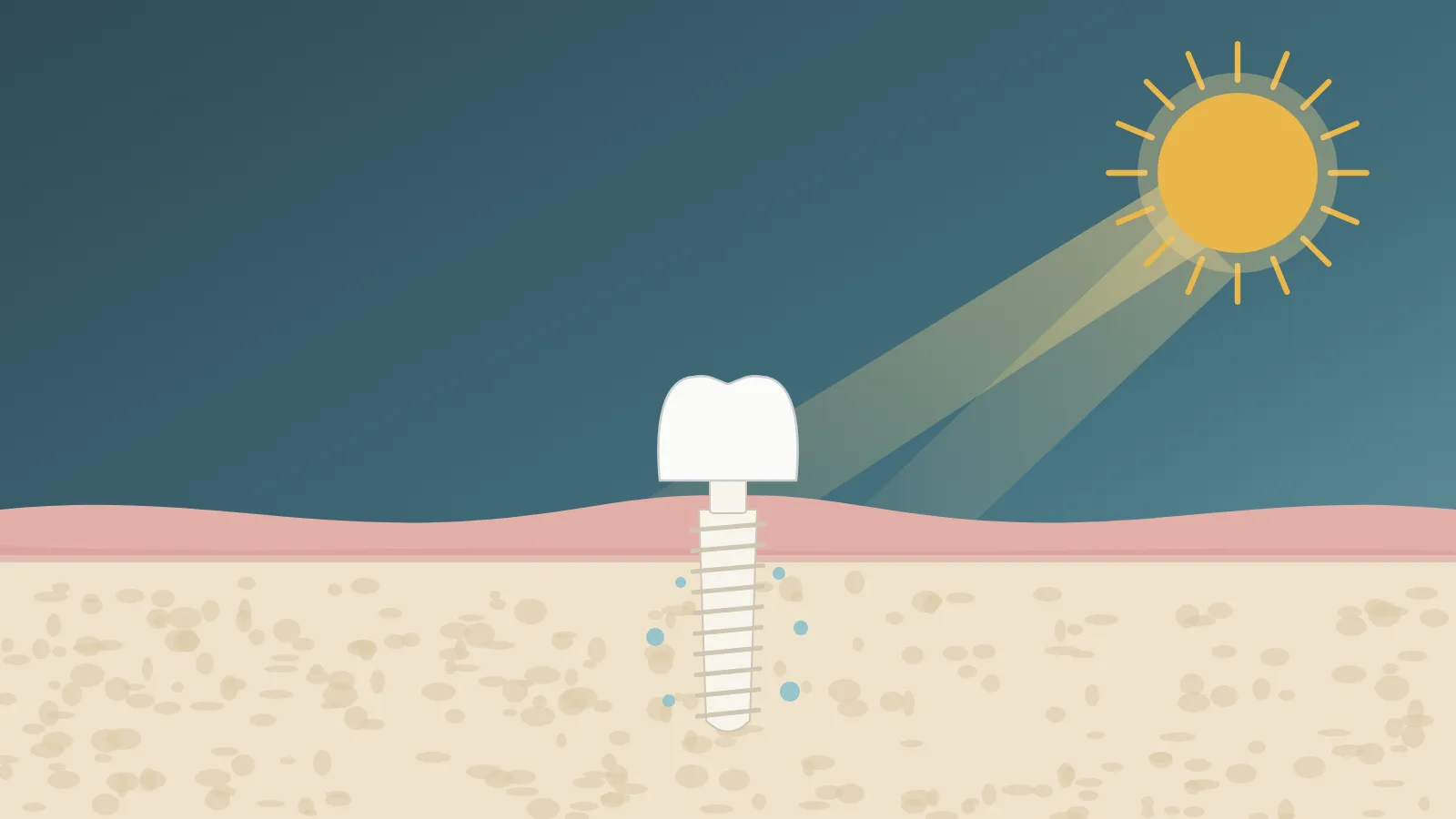 Vitamin D and Dental Implants: Preparing the Body to Heal