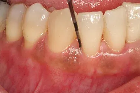 Close-up of lower front teeth and gums with a periodontal probe placed between two teeth