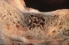 Close-up of a section of jawbone with a dark, porous area in the centre