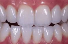 Close-up of upper and lower front teeth, including a zirconium crown