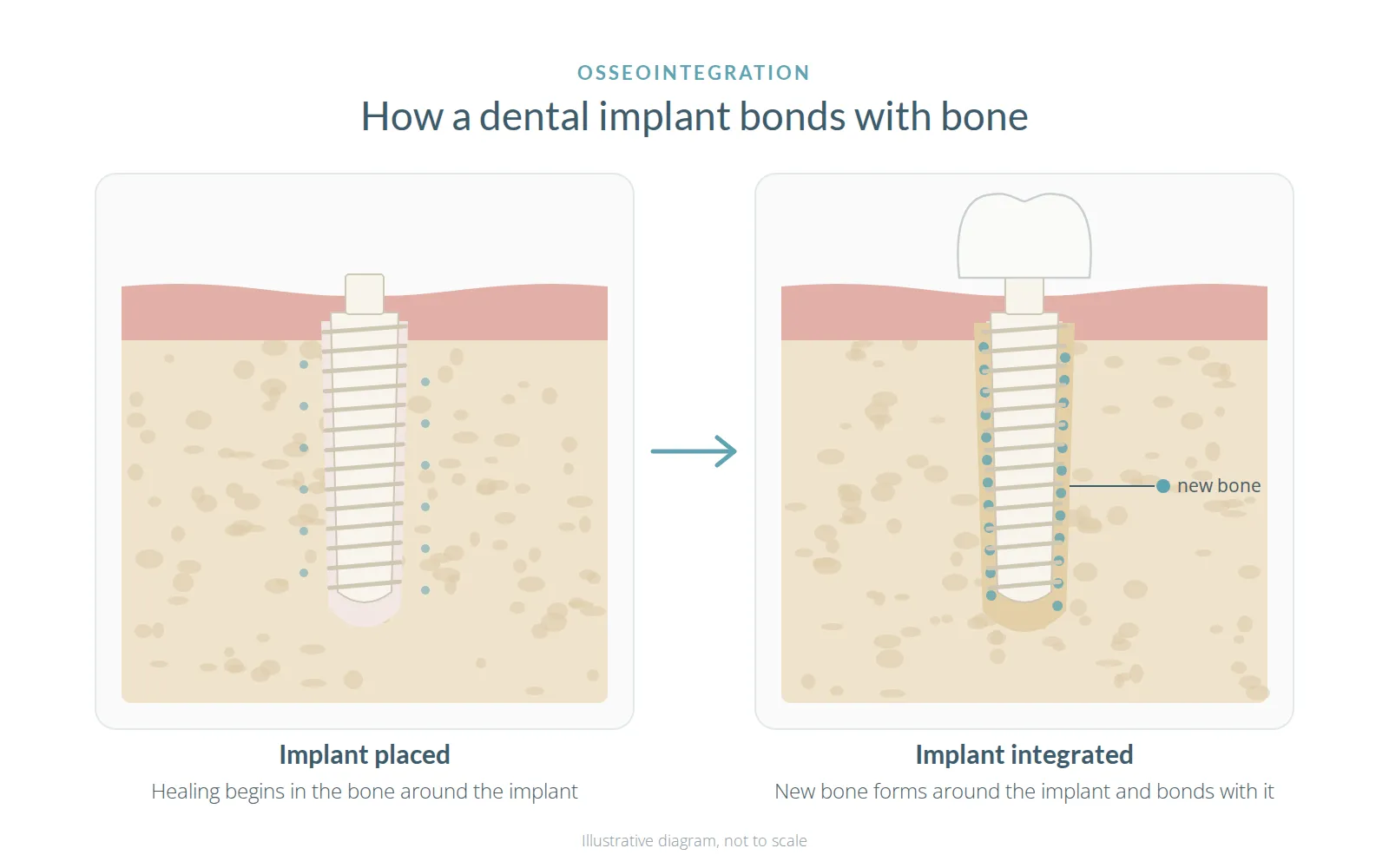 Two-panel diagram titled How a dental implant bonds with bone: implant placed, then implant integrated
