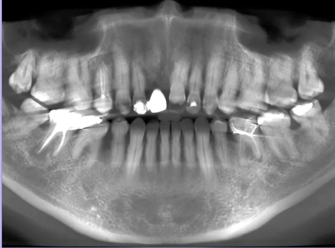 Panoramic dental X-ray of both jaws showing fillings and root canal treated teeth