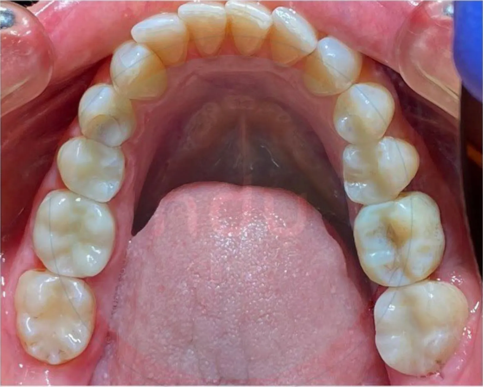 Upper teeth viewed from below, with tooth-coloured back teeth and no metal fillings visible