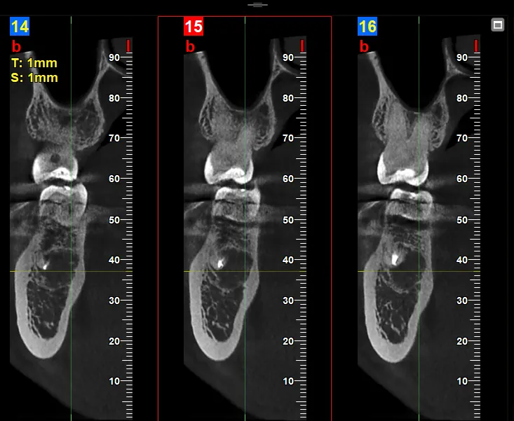 Three cone beam CT cross-sections of a tooth and jawbone, numbered 14 to 16, with a millimetre scale