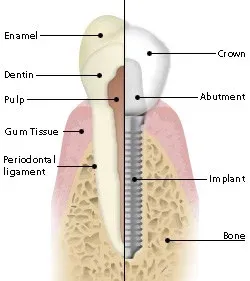 Labelled diagram comparing a natural tooth with an implant, crown and abutment in the jawbone