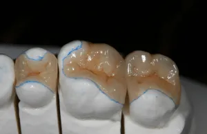 Three tooth-coloured inlays fitted to teeth on a white plaster model